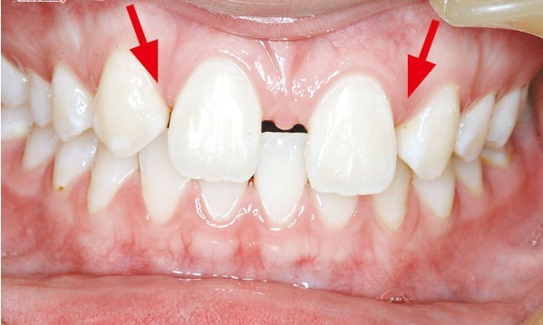 儿童先天性牙缺失怎么治疗?