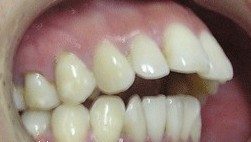 孩子牙齿错颌畸形的危害